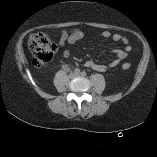 Acute cholecystitis and ureteric colic (Radiopaedia 42330-45444 Axial prone 63).jpg