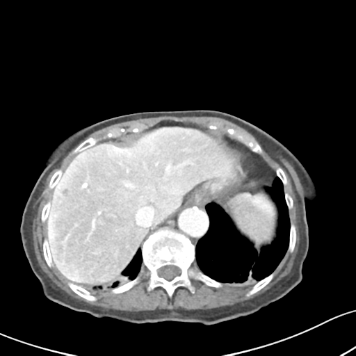 File:Acute cholecystitis with contained perforation (Radiopaedia 47328-51907 Axial C+ portal venous phase 13).png