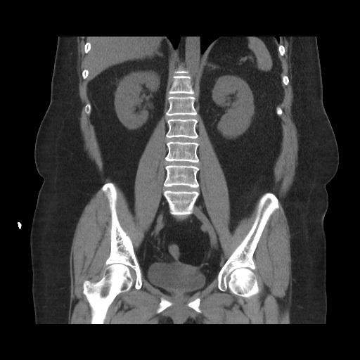 Acute cholecystitis with tensile fundus sign (Radiopaedia 71394-81723 Coronal non-contrast 78).jpg