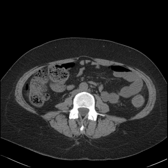 Acute colonic hemorrhage in ulcerative colitis (Radiopaedia 77415-89538 Axial non-contrast 76).jpg