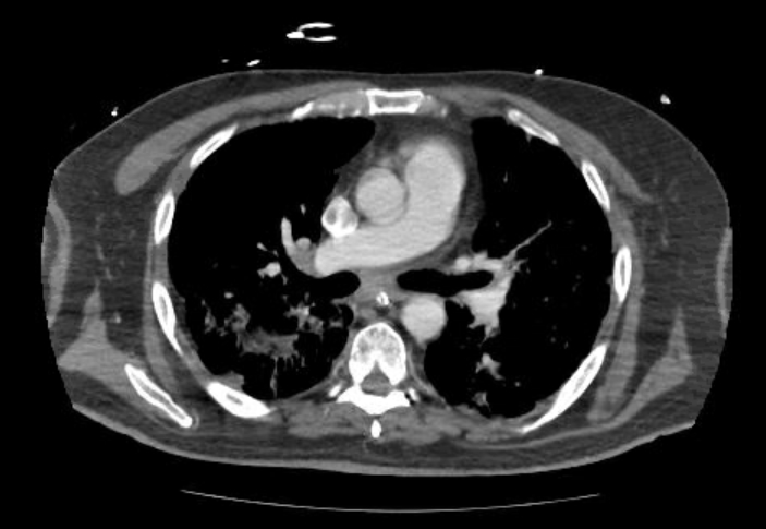Acute cor pulmonale (ultrasound) (Radiopaedia 83508-98818 Axial C+ CTPA 34).jpg
