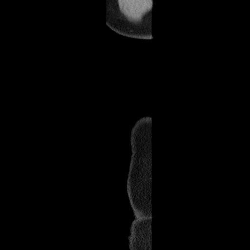 Acute diverticulitis with localized perforation (Radiopaedia 41296-44113 Sagittal C+ portal venous phase 81).jpg