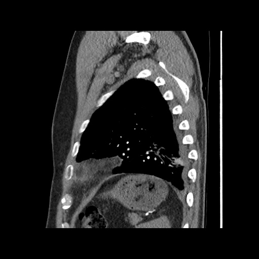 Acute epicardial fat necrosis (Radiopaedia 42327-45440 Sagittal C+ CTPA 57).jpg