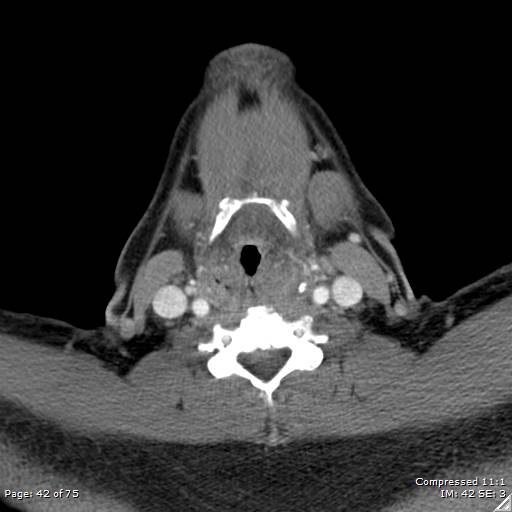 Acute epiglottitis (Radiopaedia 54375-60590 Axial C+ arterial phase 42).jpg