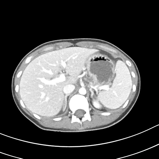 Acute gangrenous appendicitis with perforation (Radiopaedia 40152-42662 Axial C+ portal venous phase 15).png