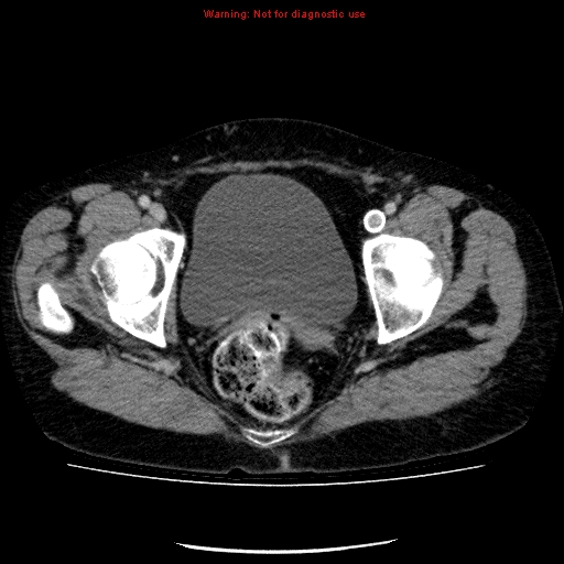 Acute gangrenous cholecystitis (Radiopaedia 10123-10661 Axial C+ portal venous phase 95).jpg
