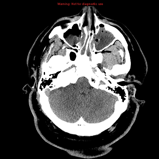 Acute hemorrhagic leukoencephalitis (Radiopaedia 14076-13920 Axial non-contrast 8).jpg