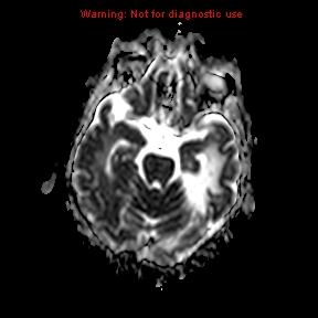 File:Acute infarction (Radiopaedia 12332-12616 Axial ADC 9).jpg