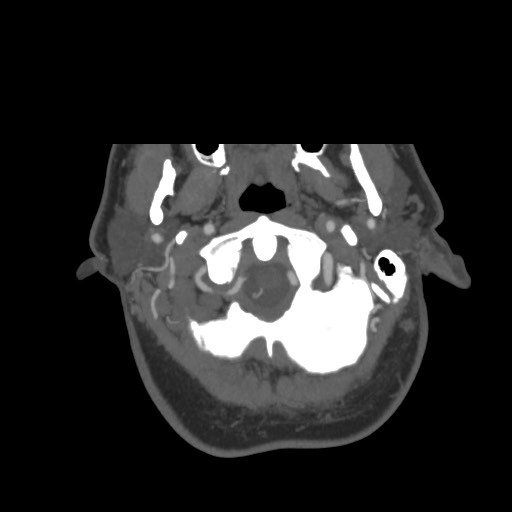 File:Acute internal carotid artery dissection (Radiopaedia 53541-59630 D 5).jpg