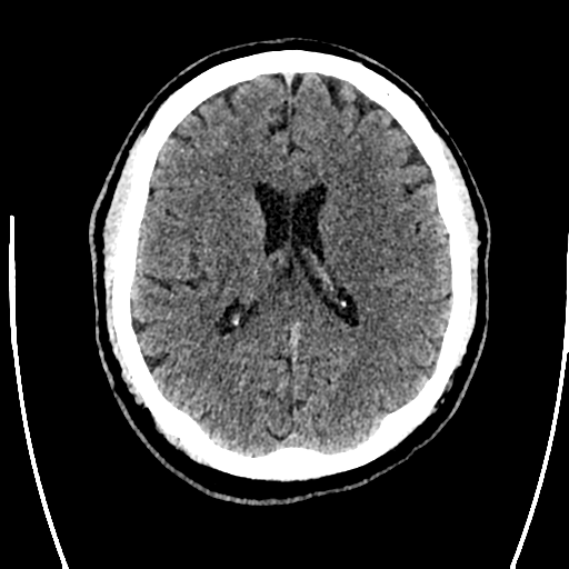 Acute left middle cerebral artery territory ischemic stroke (Radiopaedia 35688-37223 Axial non-contrast 47).png