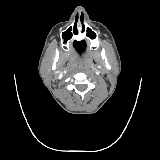 Acute longus colli calcific tendinitis (Radiopaedia 72495-83036 Axial C+ arterial phase 27).jpg