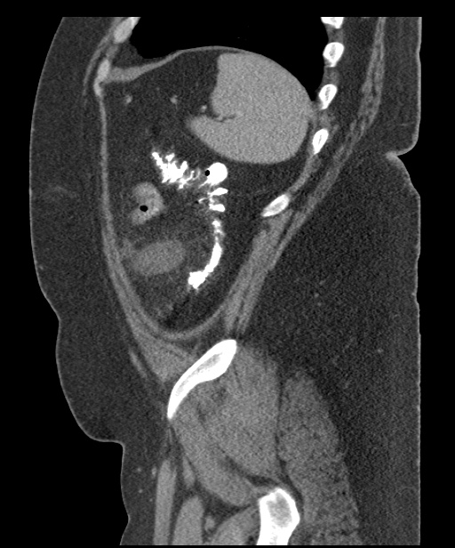 Acute mesenteric venous ischemia (Radiopaedia 46041-50383 Sagittal C+ portal venous phase 100).jpg