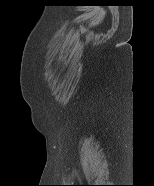 Acute mesenteric venous ischemia (Radiopaedia 46041-50383 Sagittal C+ portal venous phase 3).jpg