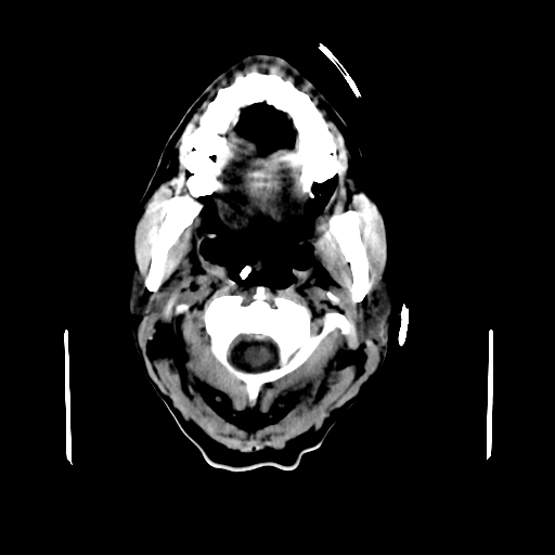 File:Acute necrotizing toxoplasma encephalitis (Radiopaedia 10683-11150 B 35).jpg