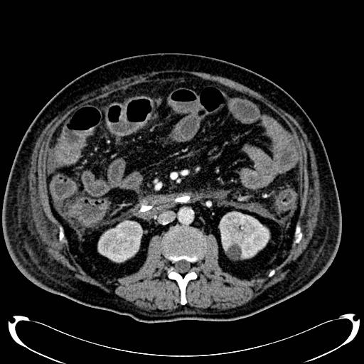 Acute pancreatic necrosis (Radiopaedia 13560-18500 Axial C+ portal venous phase 79).jpg
