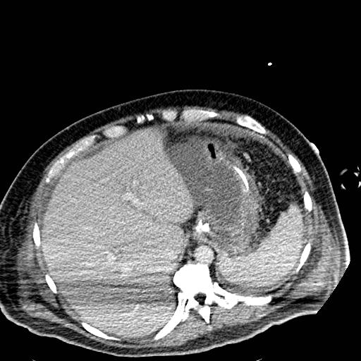 Acute pancreatic necrosis (Radiopaedia 13560-18501 Axial C+ portal venous phase 22).jpg