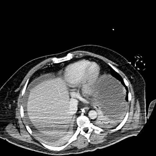 Acute pancreatic necrosis (Radiopaedia 13560-18501 Axial C+ portal venous phase 4).jpg