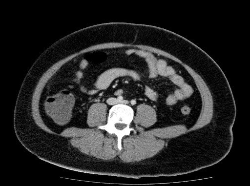 Acute pancreatitis (Radiopaedia 69236-79012 Axial C+ portal venous phase 57).jpg