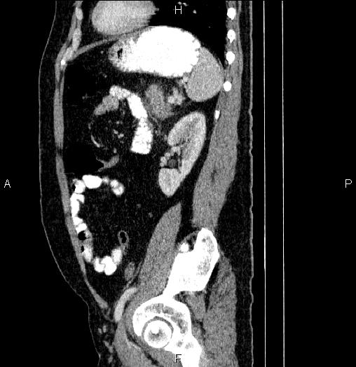 File:Acute pancreatitis (Radiopaedia 85390-101010 Sagittal C+ portal venous phase 74).jpg