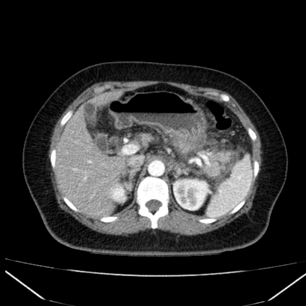 Acute pancreatitis - Balthazar C (Radiopaedia 26569-26714 Axial C+ arterial phase 26).jpg
