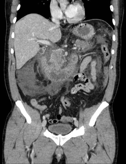Acute pancreatitis - Balthazar E (Radiopaedia 23080-23110 Coronal C+ portal venous phase 37).jpg