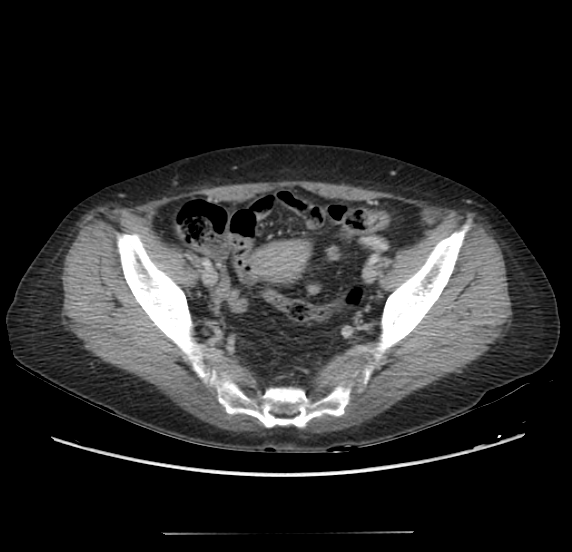 File:Acute pancreatitis - Balthazar E - post ERCP (Radiopaedia 27562-27772 Axial C+ portal venous phase 64).png