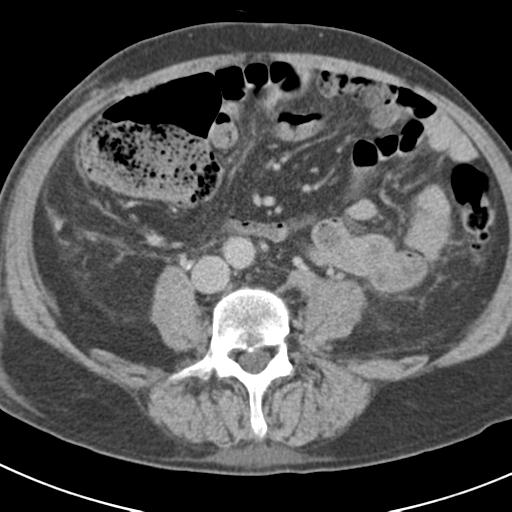 Acute pancreatitis and walled-off necrosis (Radiopaedia 29888-30403 Axial C+ delayed 51).jpg