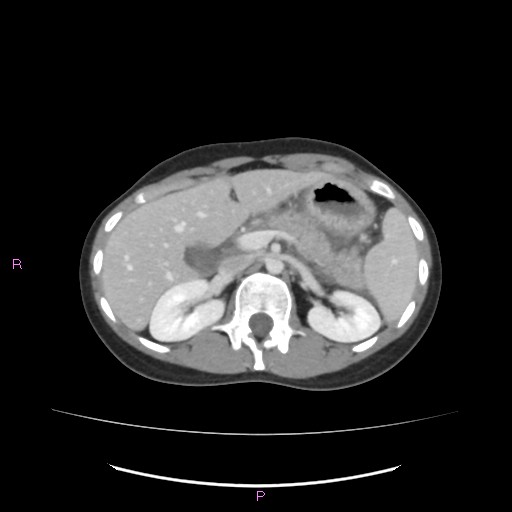 Acute pancreatitis secondary to stone at minor papilla and pancreatic divisum (Radiopaedia 76570-88333 Axial C+ portal venous phase 25).jpg