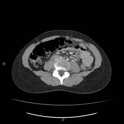 Acute pancreatitis secondary to stone at minor papilla and pancreatic divisum (Radiopaedia 76570-88333 Axial C+ portal venous phase 44).jpg