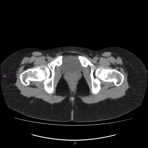 Acute pancreatitis secondary to stone at minor papilla and pancreatic divisum (Radiopaedia 76570-88333 Axial non-contrast 79).jpg