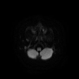 File:Acute phase of hemiconvulsion-hemiplegia epilepsy syndrome (Radiopaedia 29309-29745 Axial DWI 5).jpg