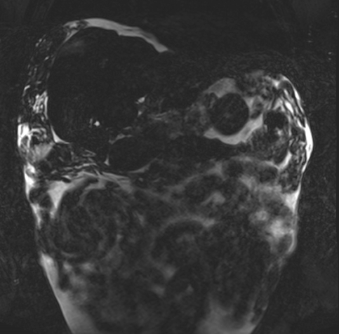 Acute portal vein thrombosis (Radiopaedia 73198-83925 Coronal Heavily T2 thin cuts 5).jpg
