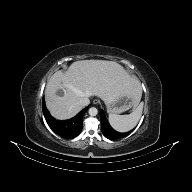 Acute pyelonephritis (Radiopaedia 25657-25837 Axial renal parenchymal phase 15).jpg
