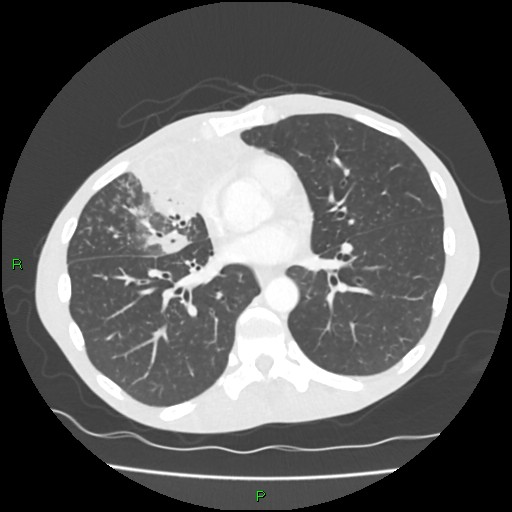 Acute right lung abscess (Radiopaedia 34806-36258 Axial lung window 112).jpg