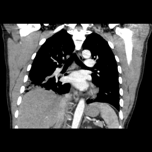 Acute segmental pulmonary emboli and pulmonary infarction (Radiopaedia 62264-70444 Coronal C+ CTPA 31).jpg