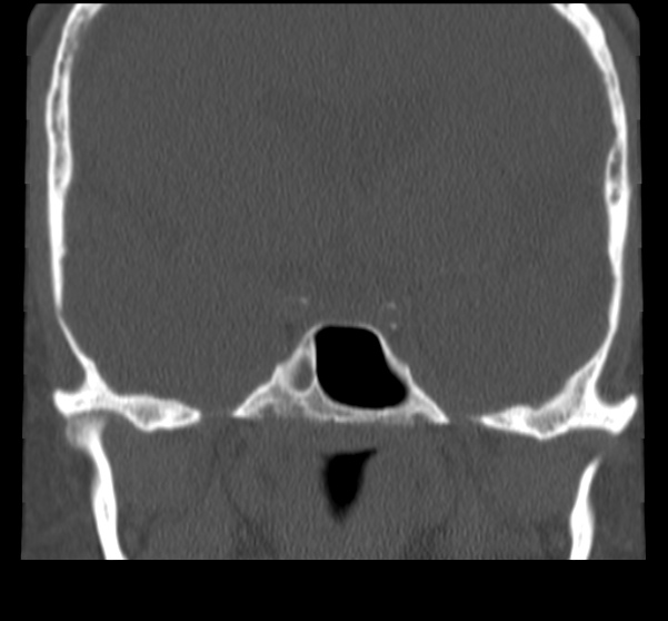 File:Acute sinusitis (Radiopaedia 23161-23215 Coronal bone window 54).jpg
