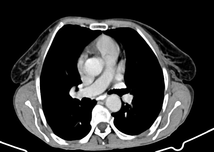 Acute small bowel (ileal) volvulus (Radiopaedia 71740-82139 Axial C+ portal venous phase 9).jpg