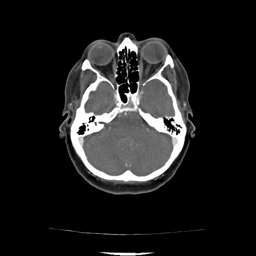 Acute subarachnoid hemorrhage and accessory anterior cerebral artery (Radiopaedia 69231-79009 Axial C+ arterial phase 85).jpg