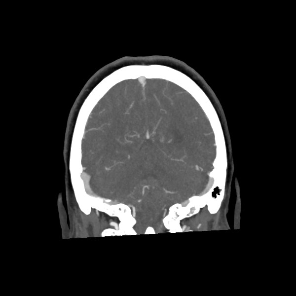 Acute subarachnoid hemorrhage and accessory anterior cerebral artery (Radiopaedia 69231-79009 Coronal C+ arterial phase 61).jpg