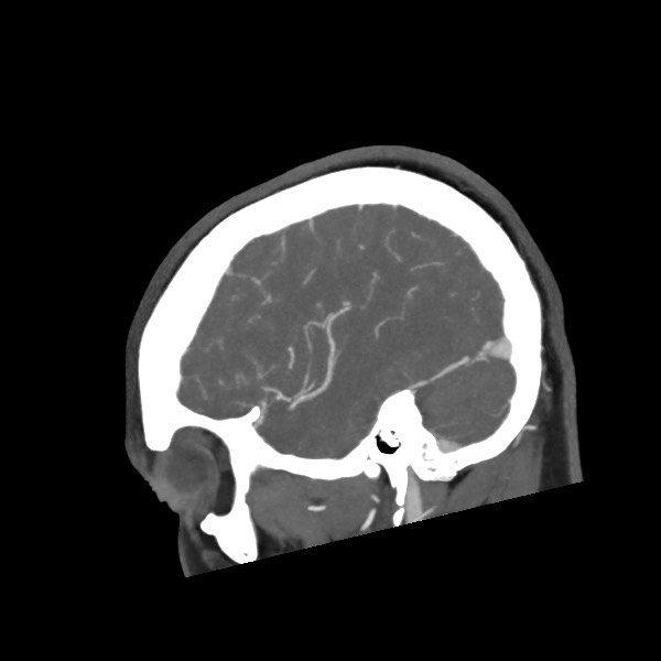 Acute subarachnoid hemorrhage and accessory anterior cerebral artery (Radiopaedia 69231-79009 Sagittal C+ arterial phase 56).jpg