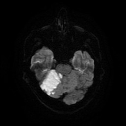 Acute superior cerebellar artery territory infarct (Radiopaedia 84104-99358 Axial DWI 56).jpg