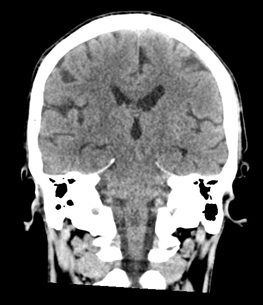 Acute superior cerebellar artery territory infarct (Radiopaedia 84104-99359 Coronal non-contrast 54).jpg