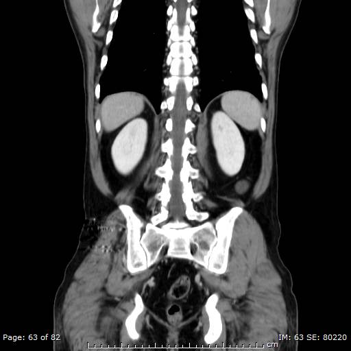 Acute superior mesenteric artery occlusion (Radiopaedia 43636-47060 Coronal C+ portal venous phase 48).jpg