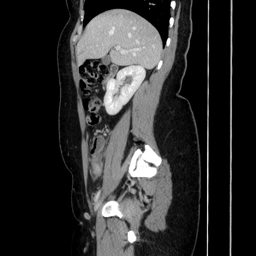 Acute uncomplicated appendicitis (Radiopaedia 73704-84499 Sagittal C+ portal venous phase 84).jpg