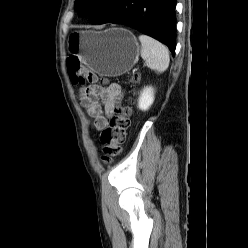 Adenocarcinoma of colon with entero-colic fistula (Radiopaedia 22832-22852 Sagittal C+ portal venous phase 54).jpg