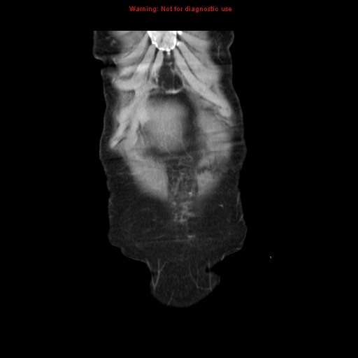 File:Adenocarcinoma of the colon (Radiopaedia 8191-9039 Coronal liver window 5).jpg