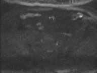 Adenocarcioma of rectum- T1 lesion (Radiopaedia 36921-38546 Axial DWI 55).png