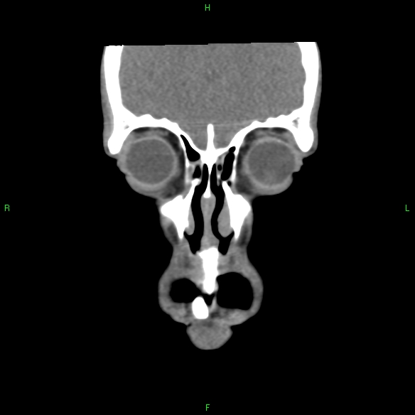 File:Adenoid cystic carcinoma of hard palate (Radiopaedia 26137-26273 Coronal liver window 3).jpg