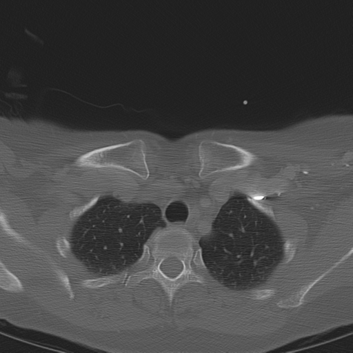 Adenoid cystic tumor of palate (Radiopaedia 46980-51518 Axial bone window 72).png
