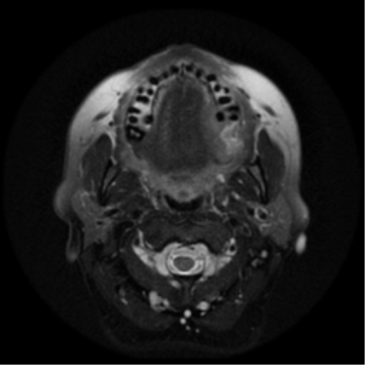 File:Adenoid cystic tumor of palate (Radiopaedia 46980-51519 Axial T2 19).png